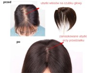 ubytki włosów na czubku głowy.jpg